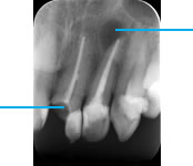 Failed root canal treatment